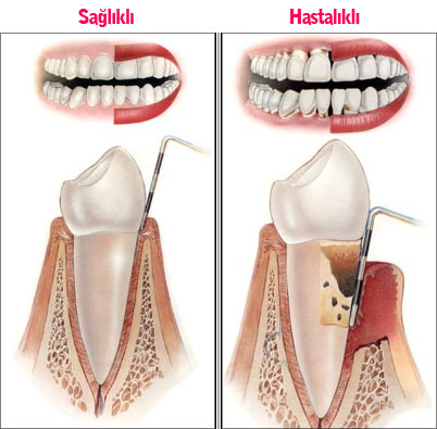 Diş eti hastalıklarının hamilelik üzerindeki etkileri