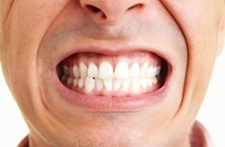 Diş sıkma alışkanlığından nasıl kurtulabilirsiniz?