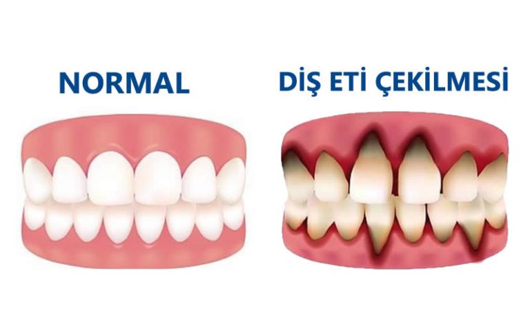 Dişeti çekilmesinin nedenleri ve tedavi yöntemleri
