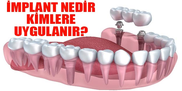 İmplant nedir ve kimlere uygulanabilir?