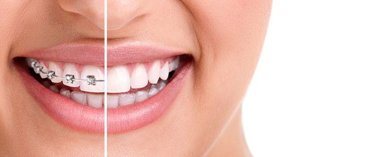 Ortodonti nedir ve nasıl uygulanır?